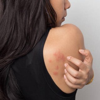 Urticaria Urticaria