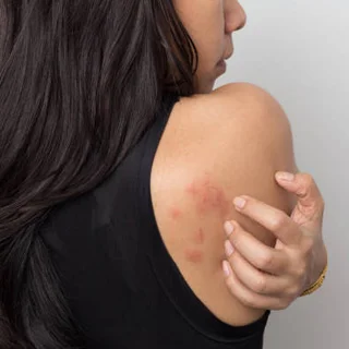 Urticaria